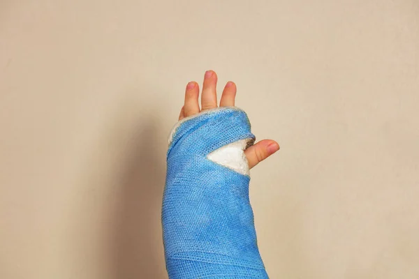 Close Uma Mão Quebrada Gesso Azul Após Foco Acidente Palma — Fotografia de Stock