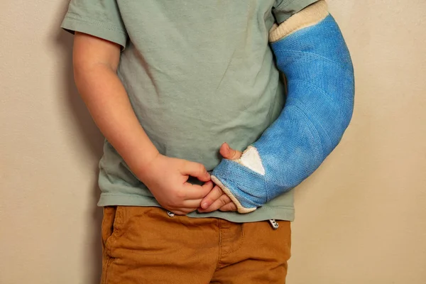 Broken hand blue plaster cast after accident torching fringes from another palm close-up