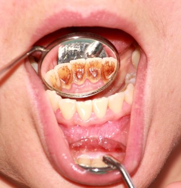 Tartar ve dental plak