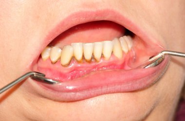 Tartar and dental plaque clipart