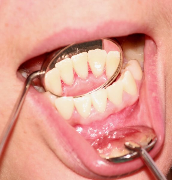 Передние зубы после удаления татара
