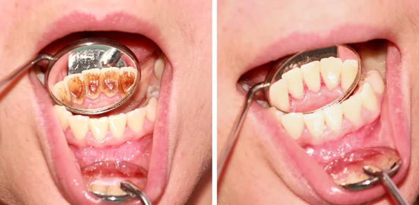 До і після видалення зубного каменю Стокове Фото