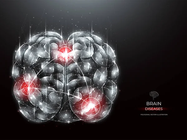 人脑炎症性疾病的多角体载体图解 大脑低度多才多艺 神经系统疾病医学横幅 模板或背景 — 图库矢量图片
