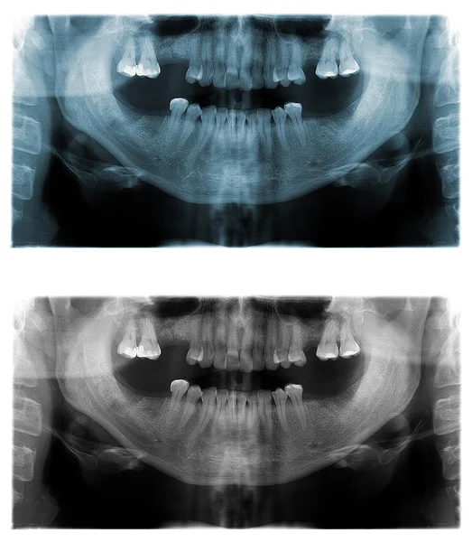 Imagens panorâmicas de raios-X dentários — Fotografia de Stock