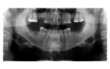 panoramik diş röntgeni diş ile
