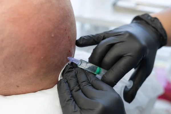 Cosmetologist makes prp therapy against baldness and hair loss to a bald man in a beauty salon. Plasma lifting procedure against baldness injection in the head. Cosmetology concept.