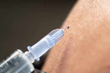 Man with hair loss problem getting injection, mesotherapy syringe injection into scalp, close up. Male client getting hair loss injection treatment