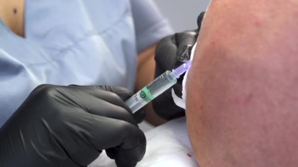 음성학 자들이나 의사들의 가까이 주사기를 대머리 남성의 피부에 머리카락 혈청을 — 비디오