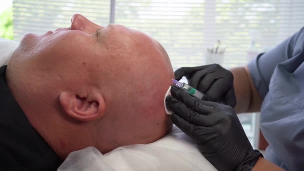 Saç Dökülmesi Için Prp Tedavisi Saç Kafa Terapisi Kafaya Enjeksiyonlar — Stok video