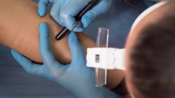Dermatologist Performs Hair Removal Procedure Patients Leg Using Electrolysis Tweezers — Stock Video