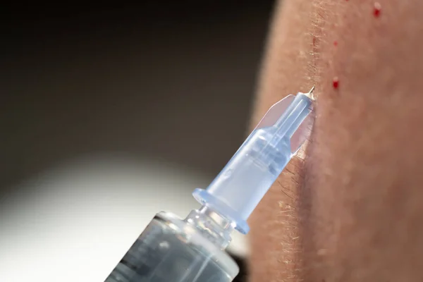 Homme Fait Injecter Dans Tête Concept Mésothérapie Fait Des Injections — Photo