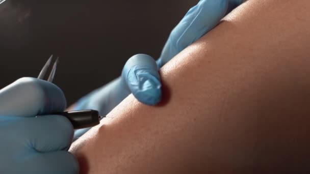 Yakın Çekim Dermatoloğu Elektroliz Kullanarak Hastaların Bacakları Üzerinde Kıl Çıkarma — Stok video