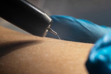 Güzellik salonunda elektroepilasyon cihazı kullanılarak istenmeyen kılların alınması işlemi. Kapat.