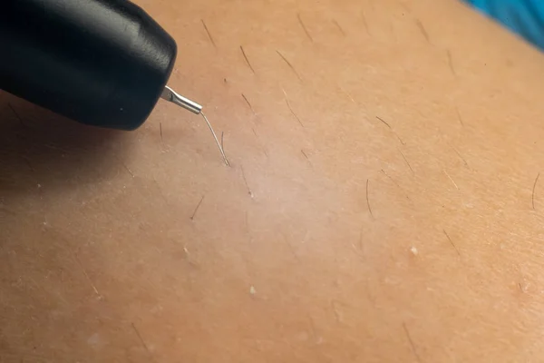 Process of permanent hair removal, removing unwanted hair using an electroepilation device, close-up macro photography.