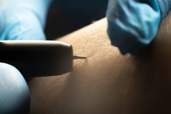 process of permanent unwanted hair removal, using an electroepilation device, close up macro photography