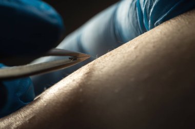 Doctor hair removal specialist, professional electro epilation hair from woman's legs with tweezers, close up. Cosmetology procedure concept