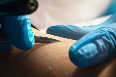 Kılların alınması, istenmeyen kılların elektroepilasyon cihazı ve cımbız kullanılarak alınması, yakın çekim makro--.