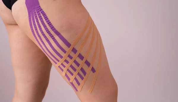 Applying Kinesiology Tape Female Patient Legs Kinesiology Taping Cellulite Procedure — Fotografia de Stock
