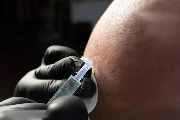 Injection Mésothérapie Dans Tête Chauve Dans Salon Beauté Gros Plan — Photo