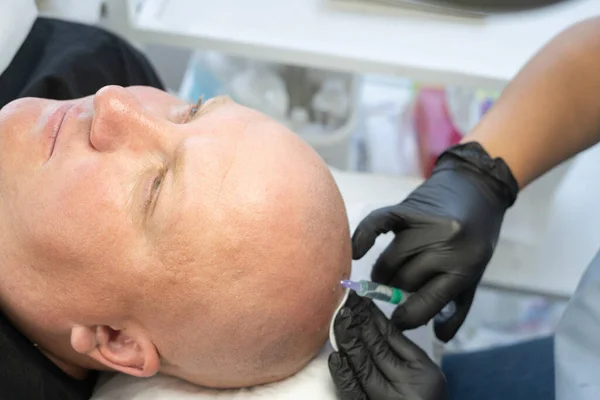 Mesotherapy of hair and head. Head injections. Fighting hair loss in men. head of a bald man and hands of a beautician trichologist, close-up