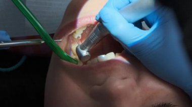 Extreme closeup shot of dental procedure on a caucasian female patient with dental turbine handpiece, mirror and saliva ejector in mouth