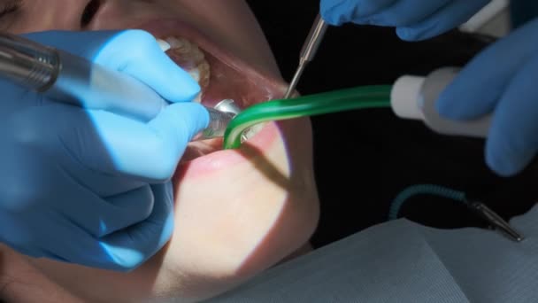 Extreme Closeup Shot Dental Procedure Caucasian Female Patient Dental Turbine — Stock videók