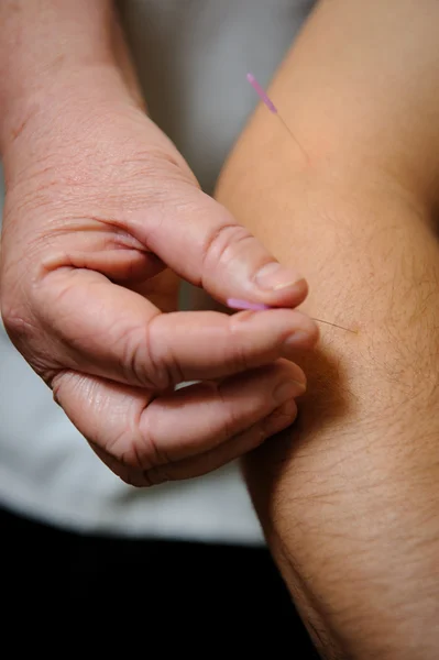 Acupuncture. Needles being inserted into a patient's skin — Stock Photo, Image