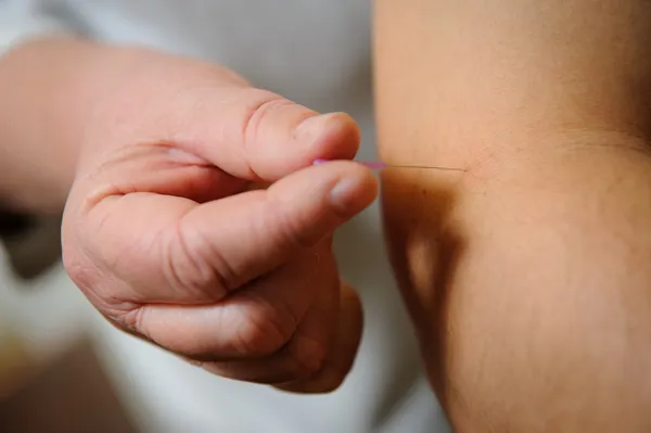 Acupuncture. Needles being inserted into a patient's skin — Stock Photo, Image