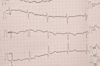 kardiyogram. EKG kalp atışı gösterir