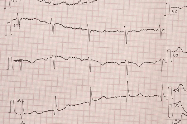 Cardiogram. ECG shows the heart beat — Stock Photo, Image