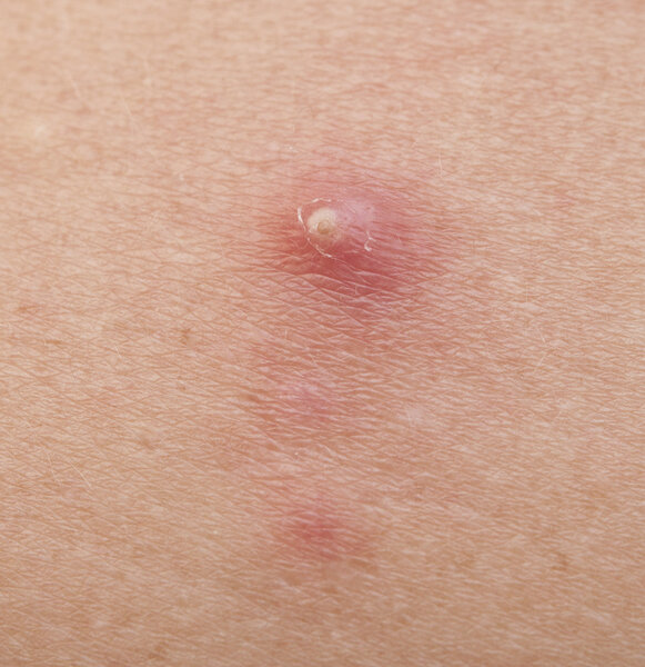 pimple extreme on human skin. macro