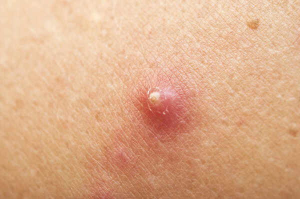 pimple extreme on human skin. macro