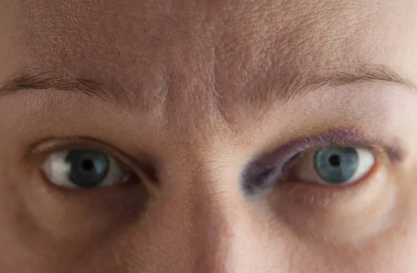 Close View Eye Beautiful Young Lady Bruising Eye Domestic Violence — Stock Photo, Image
