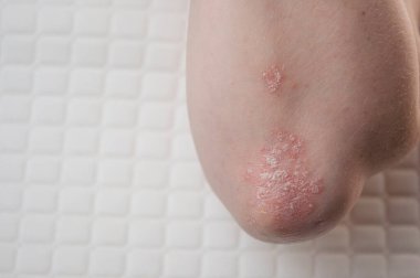 Dirseklerdeki akut sedef hastalığı otoimmün, tedavisi olmayan dermatolojik bir hastalıktır. Büyük kırmızı, iltihaplı, dirseklerinde döküntü var. Sedef hastalığından etkilenmiş eklemler.