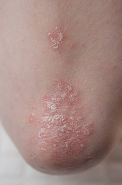 Dirseklerdeki akut sedef hastalığı otoimmün, tedavisi olmayan dermatolojik bir hastalıktır. Büyük kırmızı, iltihaplı, dirseklerinde döküntü var. Sedef hastalığından etkilenmiş eklemler.