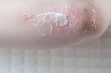 Dirseklerdeki akut sedef hastalığı otoimmün, tedavisi olmayan dermatolojik bir hastalıktır. Büyük kırmızı, iltihaplı, dirseklerinde döküntü var. Sedef hastalığından etkilenmiş eklemler.