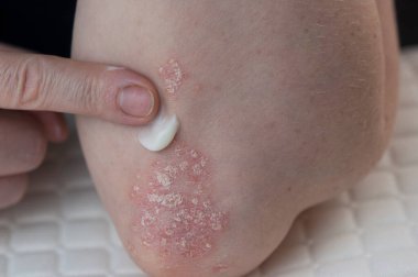 Dirseklerdeki akut sedef hastalığı otoimmün, tedavisi olmayan dermatolojik bir hastalıktır. Büyük kırmızı, iltihaplı, dirseklerinde döküntü var. Sedef hastalığından etkilenmiş eklemler.