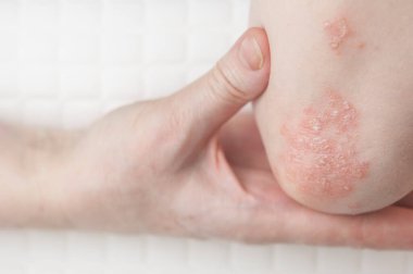 Dirseklerdeki akut sedef hastalığı otoimmün, tedavisi olmayan dermatolojik bir hastalıktır. Büyük kırmızı, iltihaplı, dirseklerinde döküntü var. Sedef hastalığından etkilenmiş eklemler.