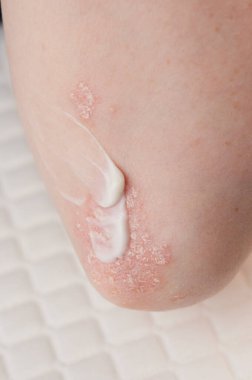 Dirseklerdeki akut sedef hastalığı otoimmün, tedavisi olmayan dermatolojik bir hastalıktır. Büyük kırmızı, iltihaplı, dirseklerinde döküntü var. Sedef hastalığından etkilenmiş eklemler.