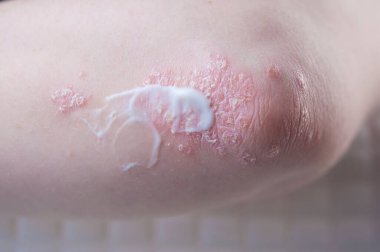 Dirseklerdeki akut sedef hastalığı otoimmün, tedavisi olmayan dermatolojik bir hastalıktır. Büyük kırmızı, iltihaplı, dirseklerinde döküntü var. Sedef hastalığından etkilenmiş eklemler.