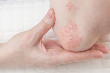 Dirseklerdeki akut sedef hastalığı otoimmün, tedavisi olmayan dermatolojik bir hastalıktır. Büyük kırmızı, iltihaplı, dirseklerinde döküntü var. Sedef hastalığından etkilenmiş eklemler.