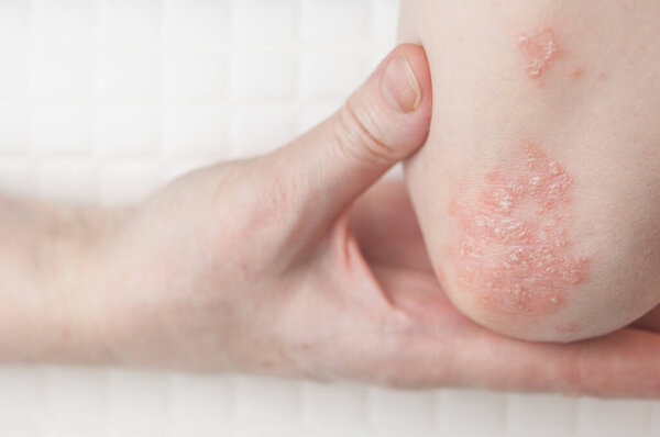 Острый псориаз на локтях является аутоиммунным неизлечимым дерматологическим заболеванием кожи. Большая красная, воспаленная, чешуйчатая сыпь на локтях. Суставы, пораженные псориатическим артритом