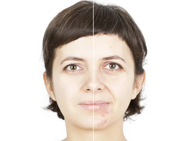 Before and after skin healing — Stock Photo, Image