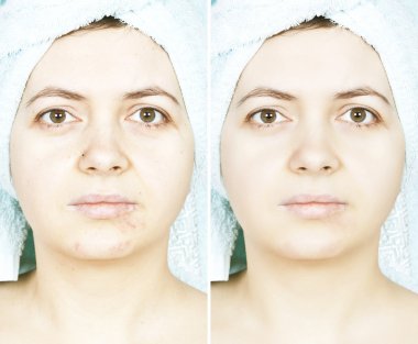 kadın ile sivilceli cilt Yildiz ve kırışıklıkların ve iyileşmiş