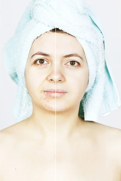 Mujer con piel manchada con cicatrices y arrugas y curada — Foto de Stock