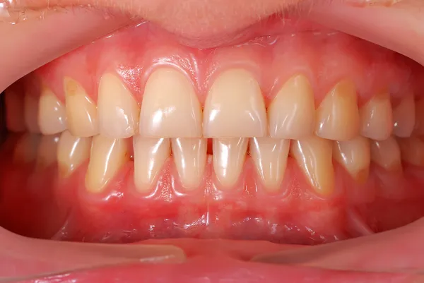 Människans tänder Stockbild