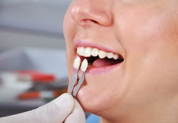 Determinazione della tonalità dente — Foto Stock