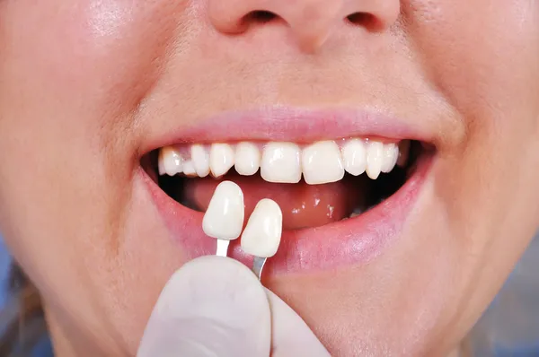 Shade determination tooth — Stock Photo, Image