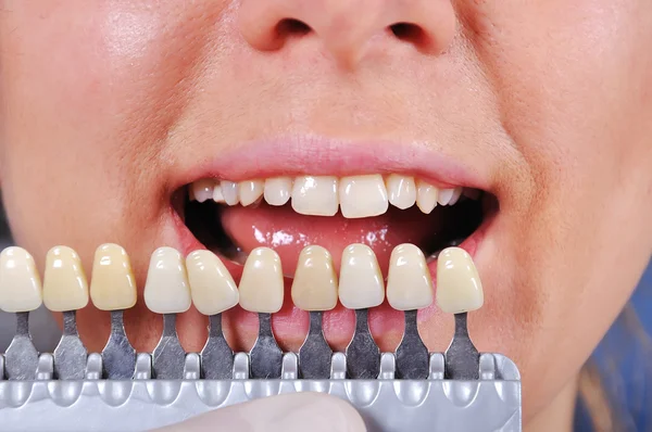 Gölge belirlenmesi diş