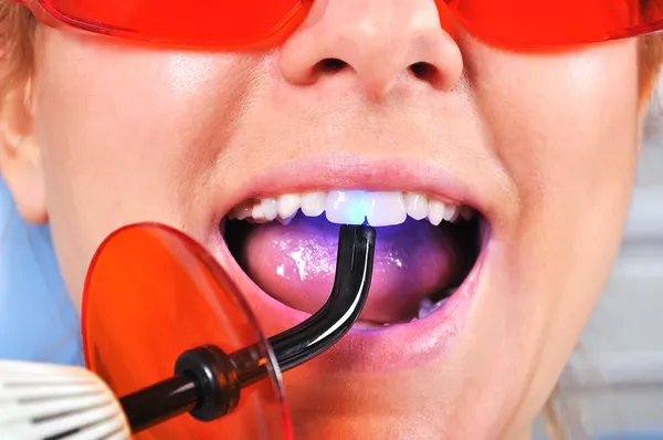 Заполнение зубов — стоковое фото